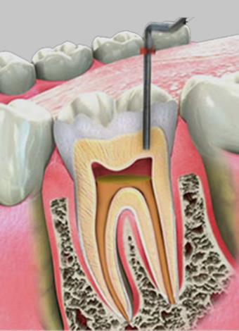 درمان ریشه دندان